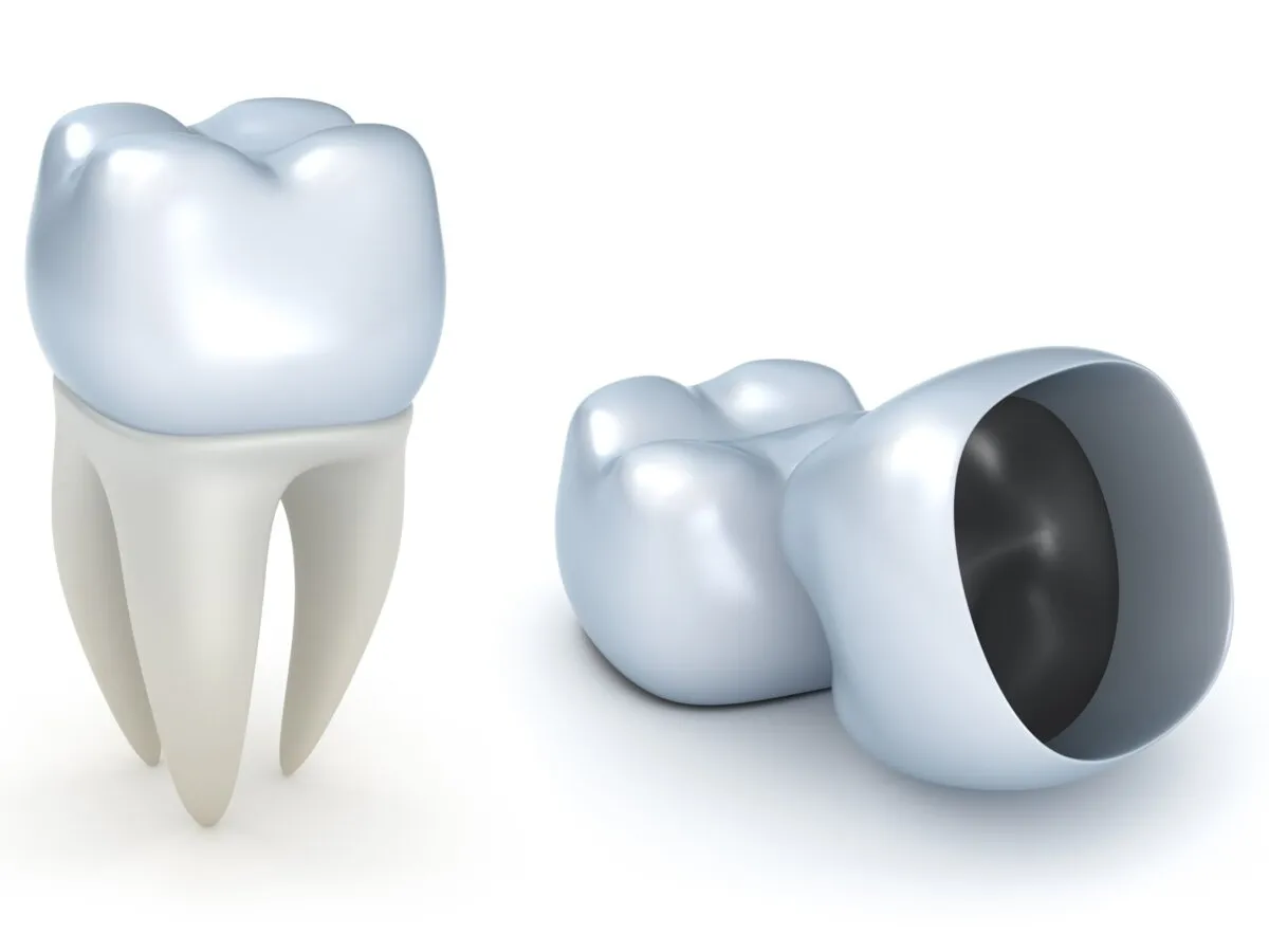 Dental Crowns and Hidden Cavities